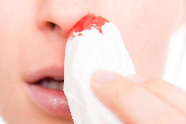 Bleeding From the Nose