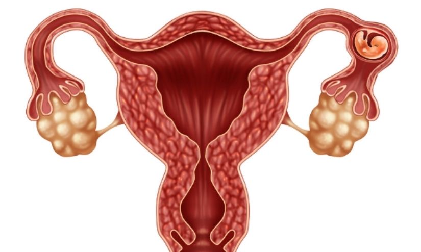 Ectopic Pregnancy