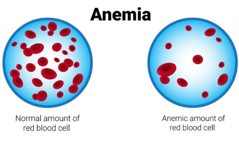 anaemia