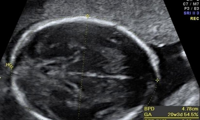 Estimation Of Fetal Weight