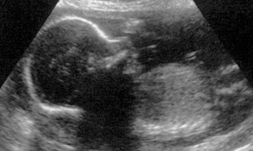 Measurement Of Abdominal Circumference