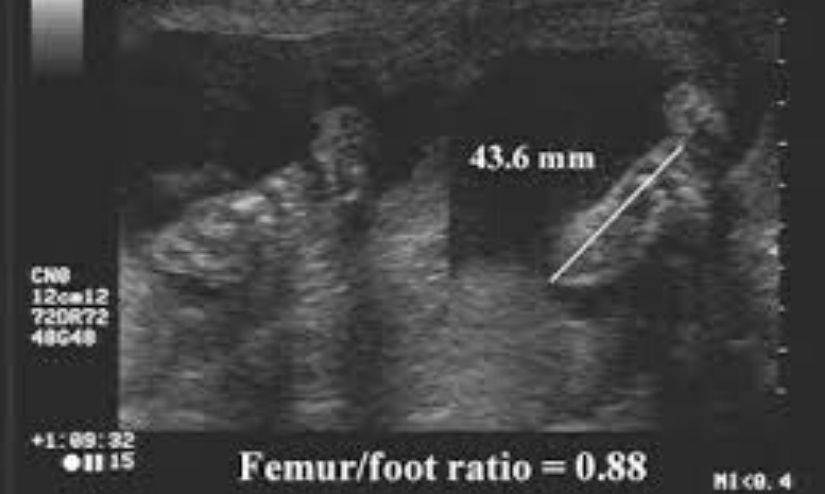 Measurement Of Femur Length
