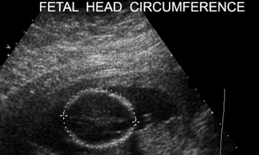 Measurement Of Head Circumference