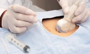 Chronic villus sampling